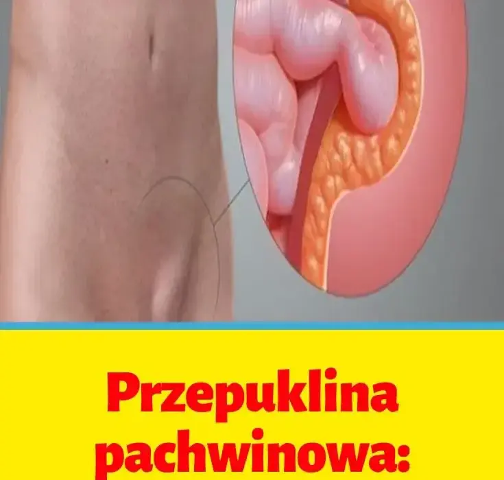 Jakiego lekarza wybrać przy przepuklinie pachwinowej? Dowiedz się teraz