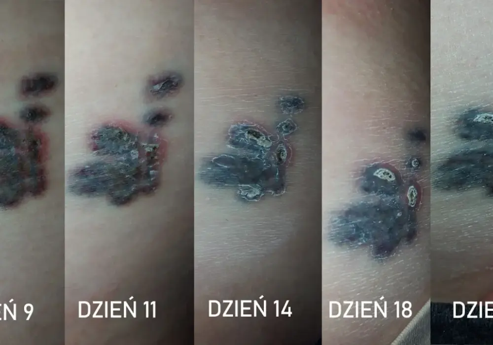 Czy antybiotyk po tatuażu szkodzi? Wszystko o bezpieczeństwie i gojeniu