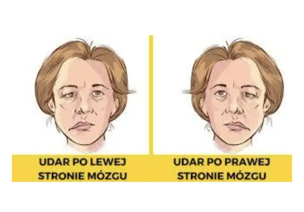 Który udar jest groźniejszy: prawostronny czy lewostronny? Porównanie skutków i rokowania