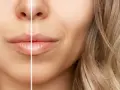 Przed i po zabiegu buccal fat removal: subtelne wygładzenie policzków, podkreślenie rysów twarzy.