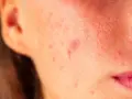 Pryszcz który nie znika: co oznacza i kiedy iść do dermatologa