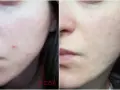 Przed i po: skóra z niedoskonałościami i zaczerwienieniami, a następnie wygładzona i oczyszczona. Kwas glikolowy efekty widoczne!