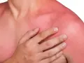 En person med kraftigt solbränd, röd hud på axlar och bröst. Känns som att vara allergisk mot solen.