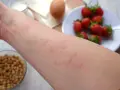 Ręka z wysypką, objawem alergii pokarmowej. W tle truskawki, jajko i nasiona.