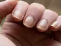 Gros plan sur des doigts montrant un ongle jaune, signe possible d'une mycose ou d'une autre affection.