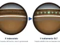 Trabeculoplastica laser selettiva: prima e dopo il trattamento SLT. Impulsi laser che migliorano il drenaggio oculare, minimizzando i rischi di cicatrici.