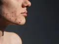 Skóra z widocznym trądzikiem u dorosłych, zaczerwienione zmiany zapalne na policzku i brodzie.
