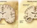 Porównanie mózgu zdrowego z mózgiem osoby z chorobą Alzheimera, ukazujące zanik kory mózgowej i hipokampa, typowe dla chorób neurodegeneracyjnych.