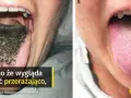 Czarny język pokryty ciemnymi włoskami, wyglądający niepokojąco, ale niegroźnie. Obok zdrowy, różowy język.