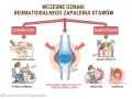 Wczesne objawy RZS: sztywność stawów, ból po bezczynności, utrata apetytu, zmęczenie, gorączka.