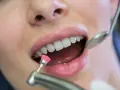 Zabieg fluoryzacji z użyciem szczoteczki i lusterka dentystycznego.