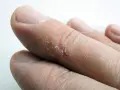 Gros plan sur des doigts aux bouts secs, la peau craquelée et desquamée.