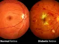 Confronto tra retina normale e retina diabetica con retinopatia diabetica proliferante, evidenziando emorragie e neovascolarizzazione.