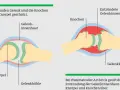 Die häufigsten Symptome der rheumatoiden Arthritis und ihre Folgen