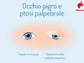 Occhio pigro e ptosi: confronto tra palpebra normale e cedimento. Ambliope cosa significa?