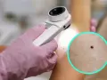 Dermatolog bada punkty rubinowe na skórze. Czerwone kropki na ciele mogą być powodem do niepokoju, ale często są niegroźne.