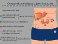Objaw Chełmońskiego, wskazujący na pęcherzyk żółciowy, zaznaczony niebieską kropką na schemacie jamy brzusznej.