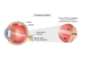 Diagramma occhio: trombosi retinica con blocco flusso sanguigno. Sintomi visivi possono manifestarsi in zone periferiche o centrali.