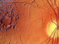 Edema maculare cistoide: la macula appare gonfia e irregolare, con aree scure che suggeriscono le cause. Vasi sanguigni retinici visibili.