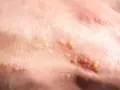 Haut mit kleinen, gelblichen Pusteln, die auf Mallorca Akne hindeuten.