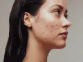 Reine Haut: Effektive Tipps gegen unreine Gesichtshaut & Pickel