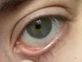 Ojo con milium en el contorno. Pequeños puntos blancos bajo la piel, un desafío para eliminar milium contorno ojos.