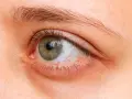 Occhi secchi di notte, con la sclera arrossata e capillari visibili. La palpebra inferiore appare leggermente gonfia.