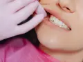 Ruszający się ząb stały? Nie wyrywaj! Pilna pomoc dentysty