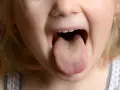 Dziecko pokazuje język z widocznym żółtym nalotem.