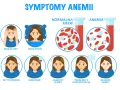 Objawy anemii u niemowlaka: bóle głowy, bezsenność, płytki oddech, zmęczenie, zawroty głowy, problemy z koncentracją, bladość skóry.