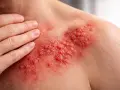 Eruzione cutanea rossa con vescicole, tipica dei sintomi del fuoco di Sant'Antonio, su una spalla.