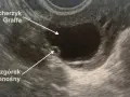 Pęcherzyk 18 mm: Kiedy owulacja? Przewodnik dla starających się o dziecko