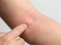 Rote, trockene Haut am Arm, die auf Neurodermitis hindeutet. Eine Hand berührt die betroffene Stelle, um zu zeigen, was hilft gegen Neurodermitis.