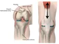 Anatomia stawu rzepkowo udowego: rzepka, kość udowa, rowek międzykłykciowy i kość piszczelowa. Strzałki pokazują ruch.