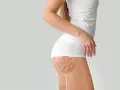 Nahaufnahme der Cellulite am Oberschenkel einer Frau. Hier wird gezeigt, was hilft gegen Cellulite.