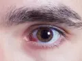 Occhio con sclera arrossata e iride marrone, suggerisce un'abrasione corneale dovuta a occhio secco.