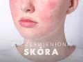 Uczucie gorąca i czerwona twarz, widoczne zaczerwienienie na policzkach.