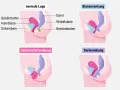 Schematische Darstellung des Beckenbodens: Normale Lage, Blasensenkung, Gebärmuttersenkung und Darmsenksung nach der Geburt.