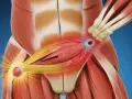 Anatomie montrant une déchirure abdominale, avec des zones rouges indiquant la douleur et l'inflammation. Symptômes d'une déchirure abdominale.