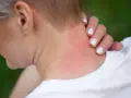 Jak wygląda alergia skórna zdjęcia - poznaj objawy i ich wygląd