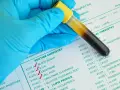 Kreatynina z czego badanie? Poznaj kluczowe informacje o testach nerkowych