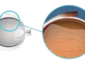 Illustrazione anatomica dell'occhio che mostra il distacco posteriore di vitreo, cosa significa questa condizione.