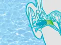 Illustration zeigt ein Kind, das Wasser im Ohr hat. Ein Stöpsel schützt das Ohr vor weiterer Flüssigkeit.