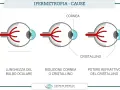 Illustrazione delle cause dell'ipermetropia: bulbo oculare corto, cornea o cristallino ridotti, o potere refrattivo del cristallino.