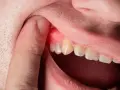 Zapalenie dziąseł? Skuteczne płukanki i kiedy do dentysty