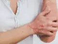 Skóra dłoni i ramienia pokryta łuszczącymi się zmianami, objaw tocznia układowego.
