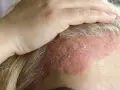Dłoń dotyka czoła z zaczerwienioną skórą i łuszczącą się skorupą na głowie, wskazującą na problem dermatologiczny.