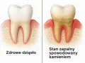 Porównanie zdrowego zęba z zębem zaatakowanym przez kamień nazębny, który powoduje stan zapalny. Co rozpuszcza kamień nazębny?