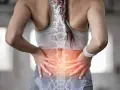 Kobieta z bólem w odcinku lędźwiowym kręgosłupa, wskazującym na dyskopatię lędźwiową i jej objawy neurologiczne.