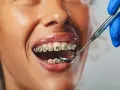 Uśmiechnięta twarz z widocznym aparatem stałym metalowym na zębach. Dentysta bada zęby lusterkiem.